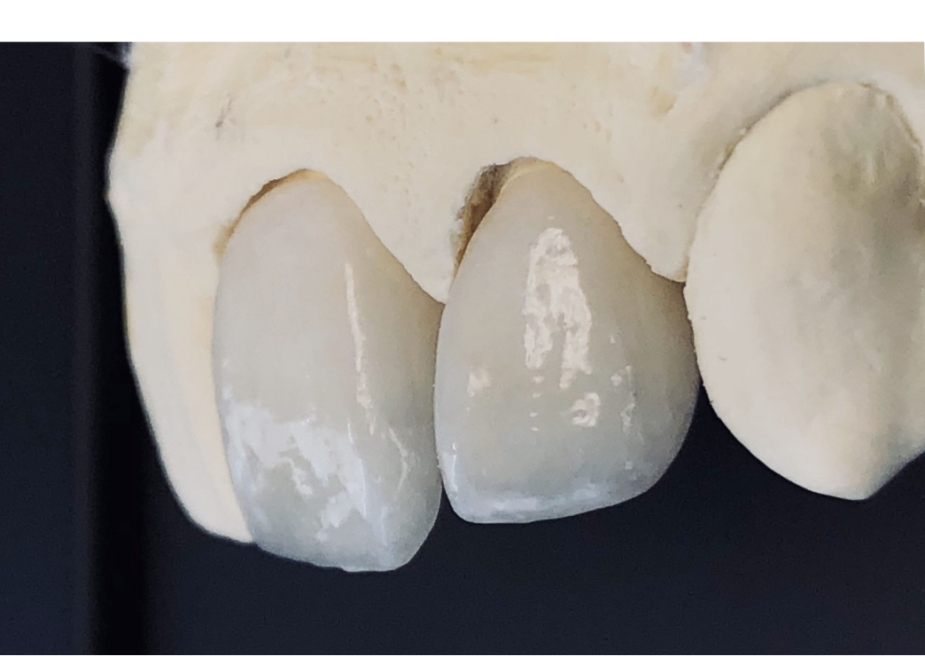 E.max Inlay & Onlay dental laboratory solution